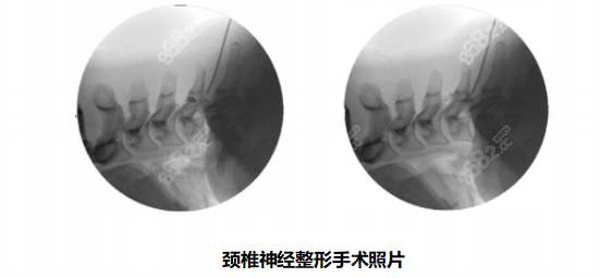 颈神经手术前后对比