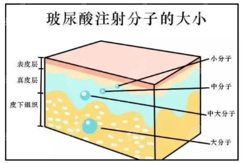 西安国医整形医院打玻尿酸多少钱