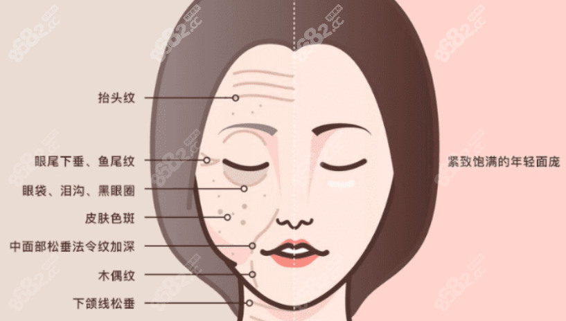 面部提升手术