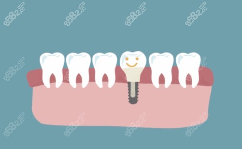 合肥贝杰口腔种植牙多少钱m.8682.cc