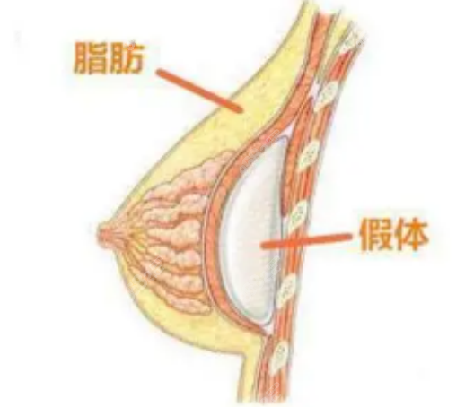 假体隆胸手术