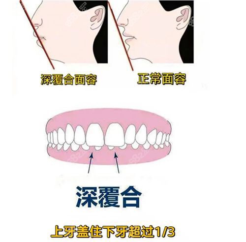 牙齿正畸脸型变丑的情况在于牙弓骨性支撑不足m.8682.cc.jpg