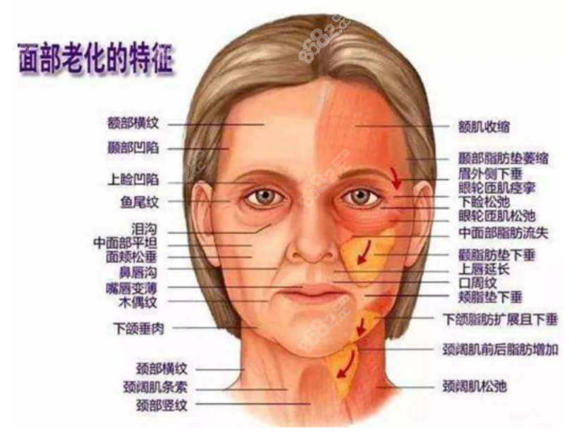 面部拉皮手术