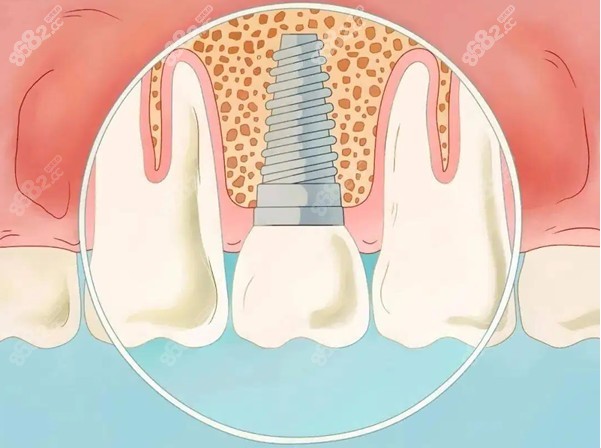 上颌窦内提升术过程图片