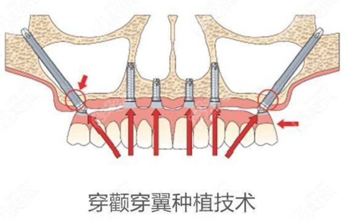 穿颧穿翼种植牙技术