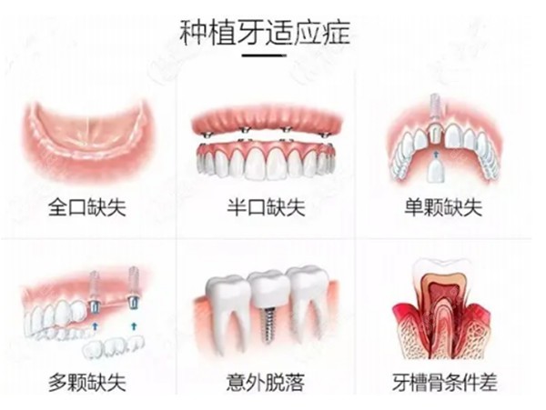 常宁口腔医院种植牙价格