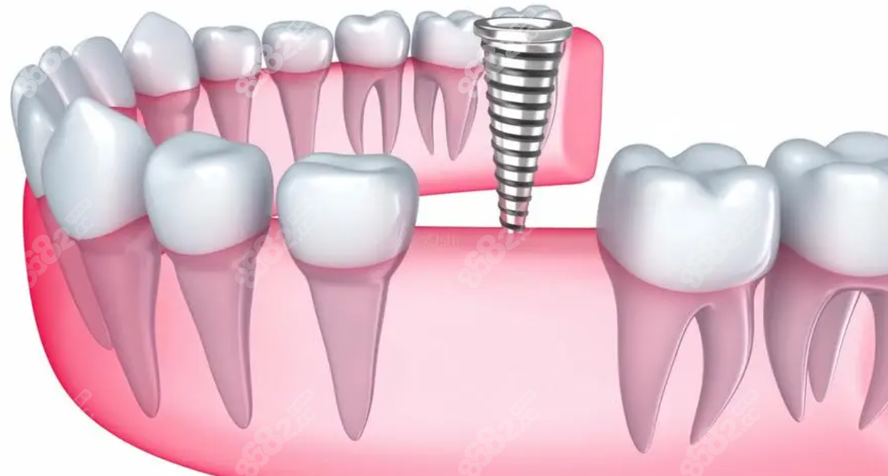 种植牙过程图