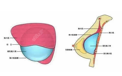 韩国必妩假体隆胸到底好不好