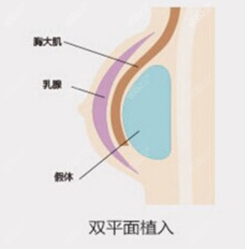 假体隆胸手术