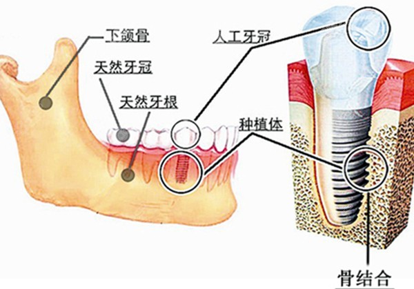 种植牙跟天然牙的对比