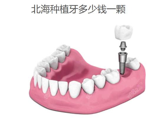 北海种植牙多少钱一颗