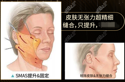 广州中家医黄广香拉皮除皱特色