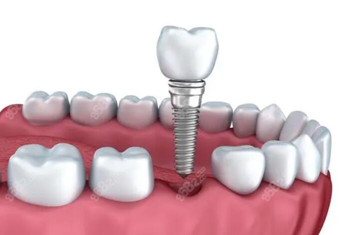 常州种植牙哪个医院好？