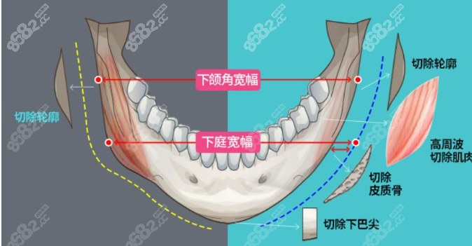 朱石江下颌角磨骨后脸型自然流畅