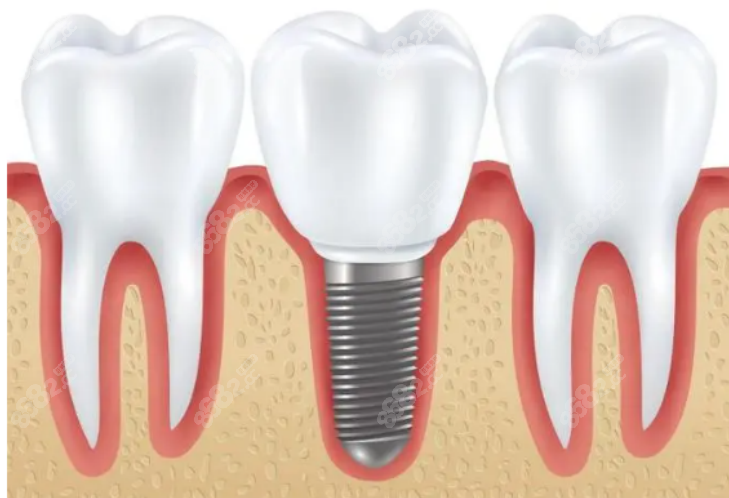 種植牙