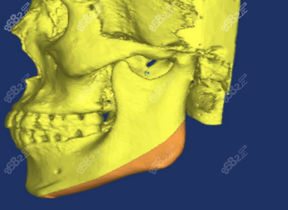 广州广大做下颌角手术怎么样