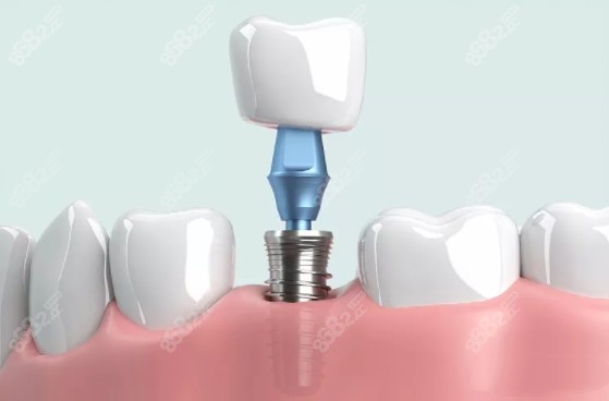 日照微笑口腔種植牙怎么樣8682.cc 日照微笑口腔種植牙怎么樣8682.cc