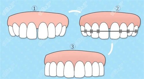 牙齿矫正过程展示图