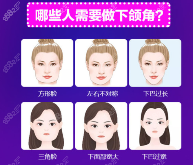 沈阳杏林朱石江做下颌角怎么样