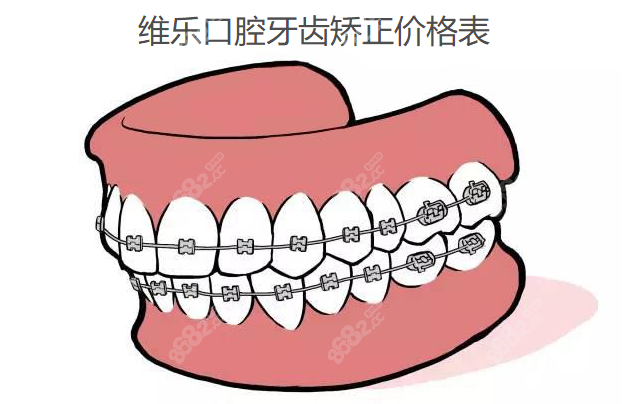 维乐口腔牙齿矫正价格表