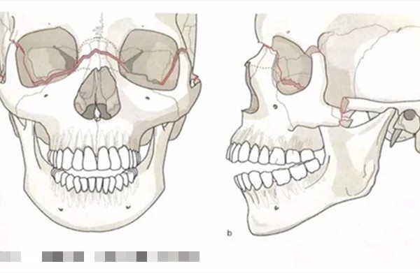 骨性正颌手术的图