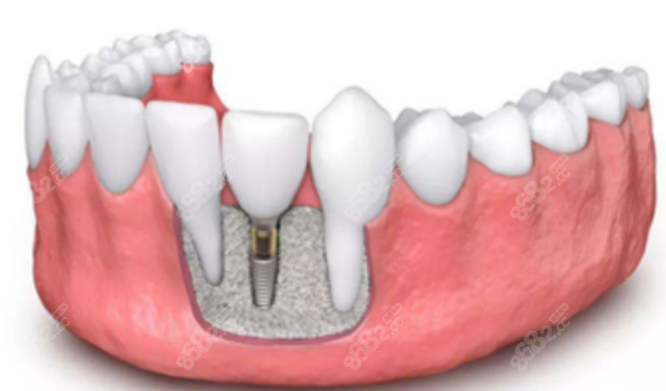 裝牙齒多少錢一顆2023價格表
