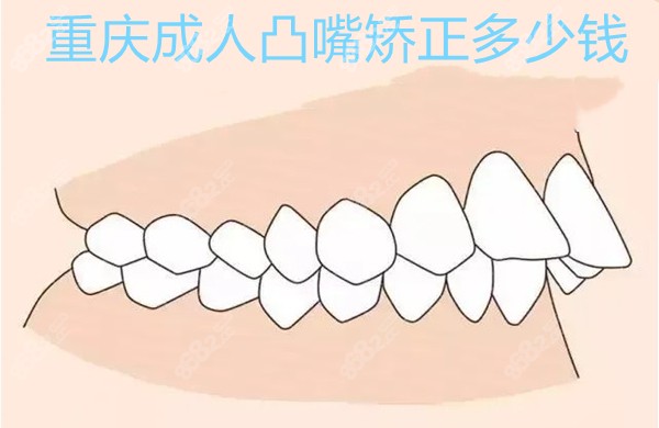 重庆成人凸嘴矫正多少钱