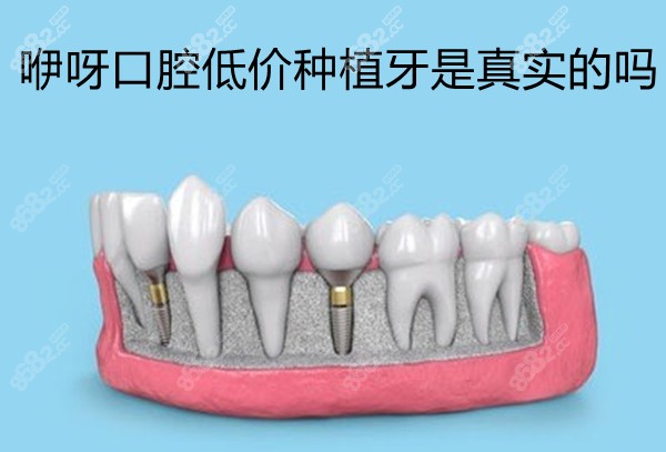 咿呀口腔低價種植牙是真實的嗎 咿呀口腔低價種植牙是真實的嗎