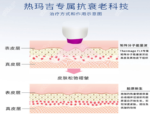 热玛吉