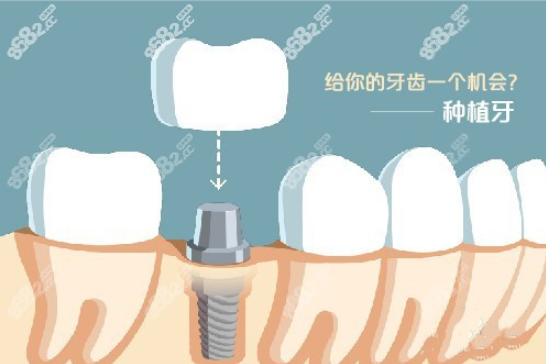 种植牙图示