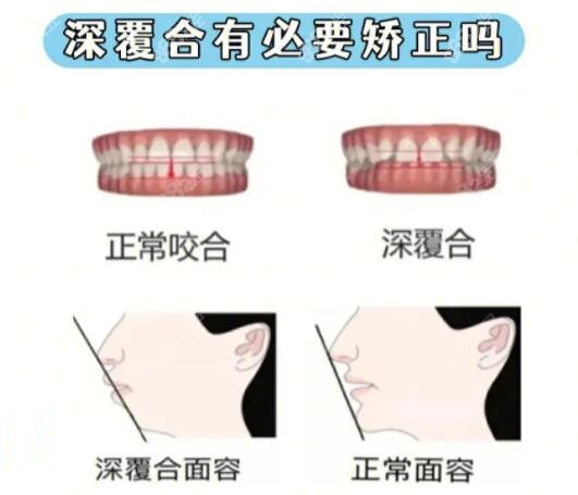 牙齿深覆合一定要做矫正吗m.8682.cc