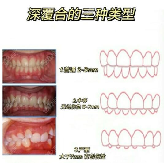 深覆合三个程度怎么区分