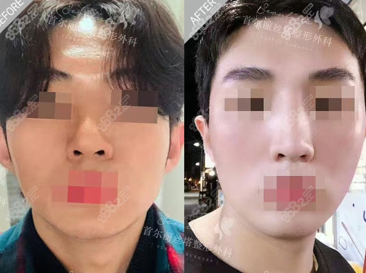 首尔丽丝塔医院做鼻修复好