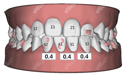 牙齿矫正图片