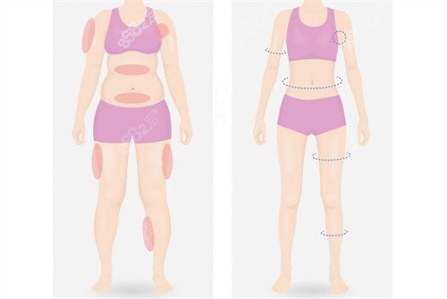 体雕吸脂可以塑形