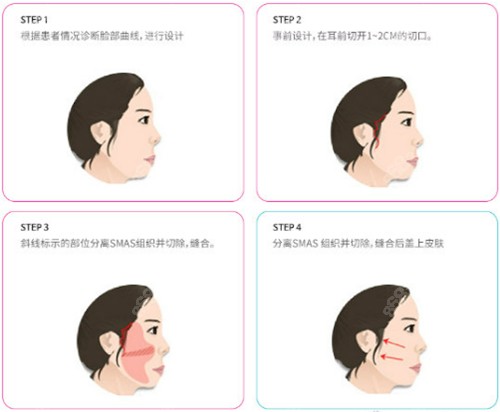 韩国迪美拉皮手术优势介绍