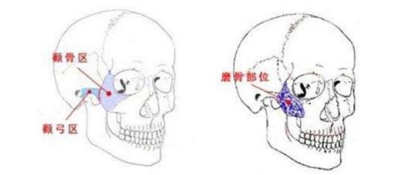 柳超颧骨颧弓内推价格表