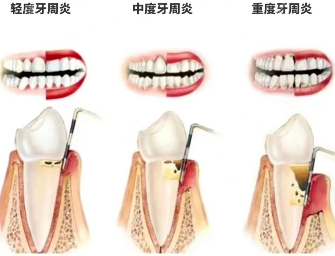 牙周炎历程