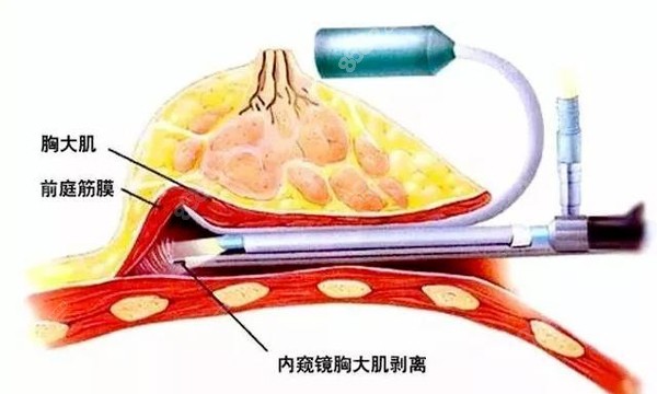 隆胸示意图