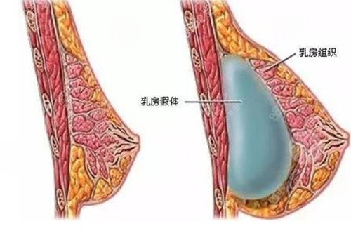 上海华美做胸怎么样