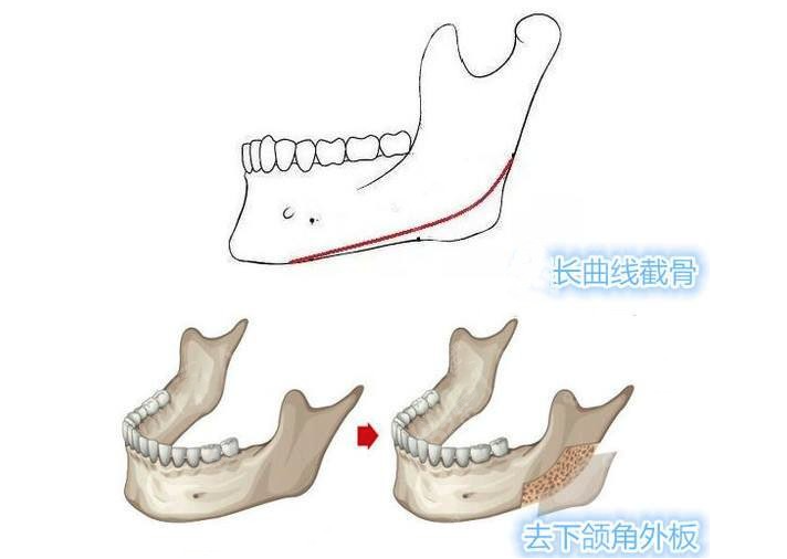 沈绍勇和邱立东磨骨风格