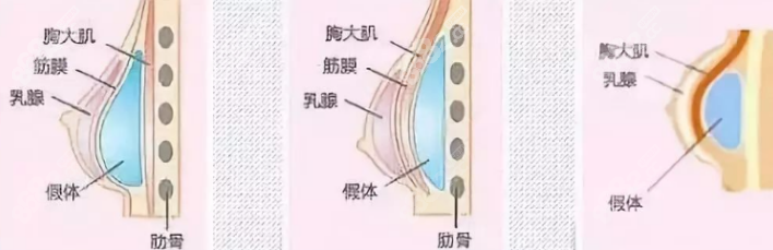 栗勇医生假体隆胸