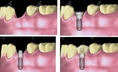 种植牙动画步骤图