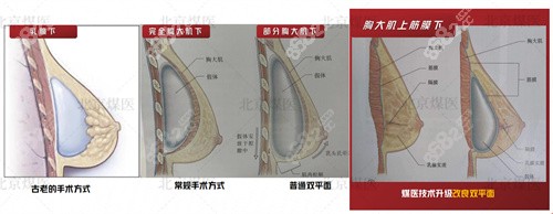 北京王驰改良版双平面隆胸位置