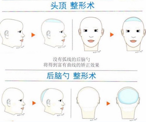 韩国雕刻骨水泥填充优势介绍