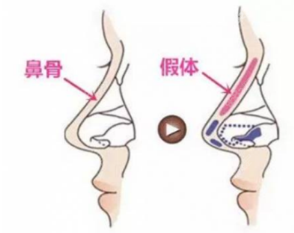 李信锋医生做鼻子