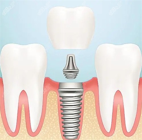种植牙照片