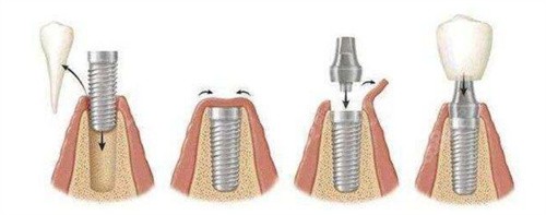 种植牙流程图