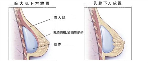 胸大肌下方放置与传统乳腺下方放置假体的区别