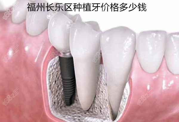 福州长乐区种植牙价格